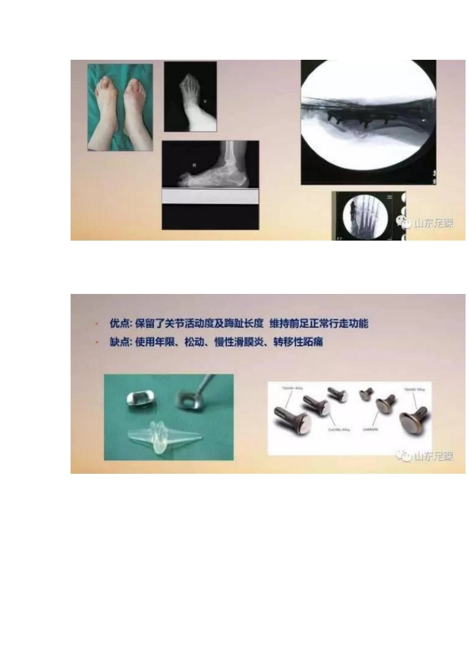拇外翻的手 术治疗技巧_第6页