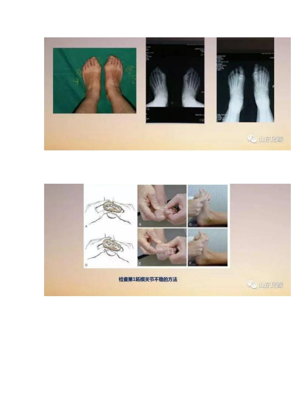 拇外翻的手 术治疗技巧_第7页