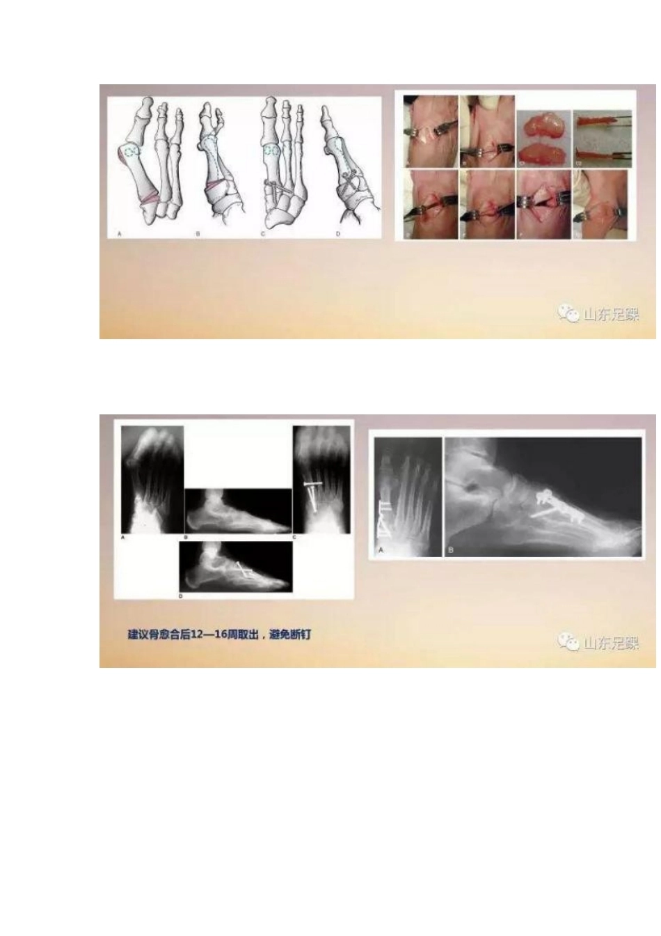 拇外翻的手 术治疗技巧_第8页