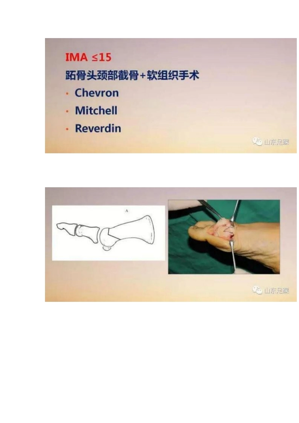 拇外翻的手 术治疗技巧_第9页
