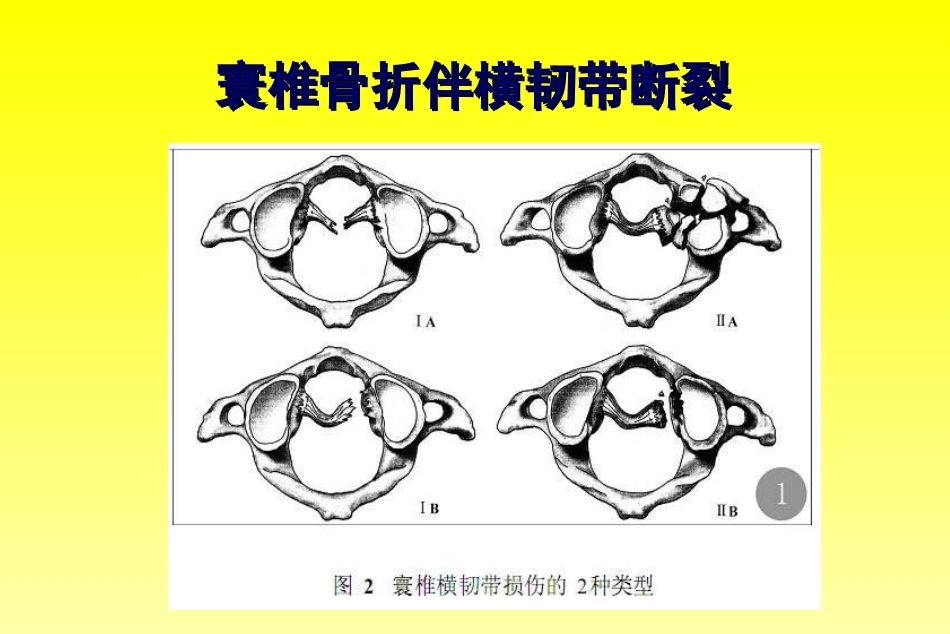 颈椎骨折分型_第9页