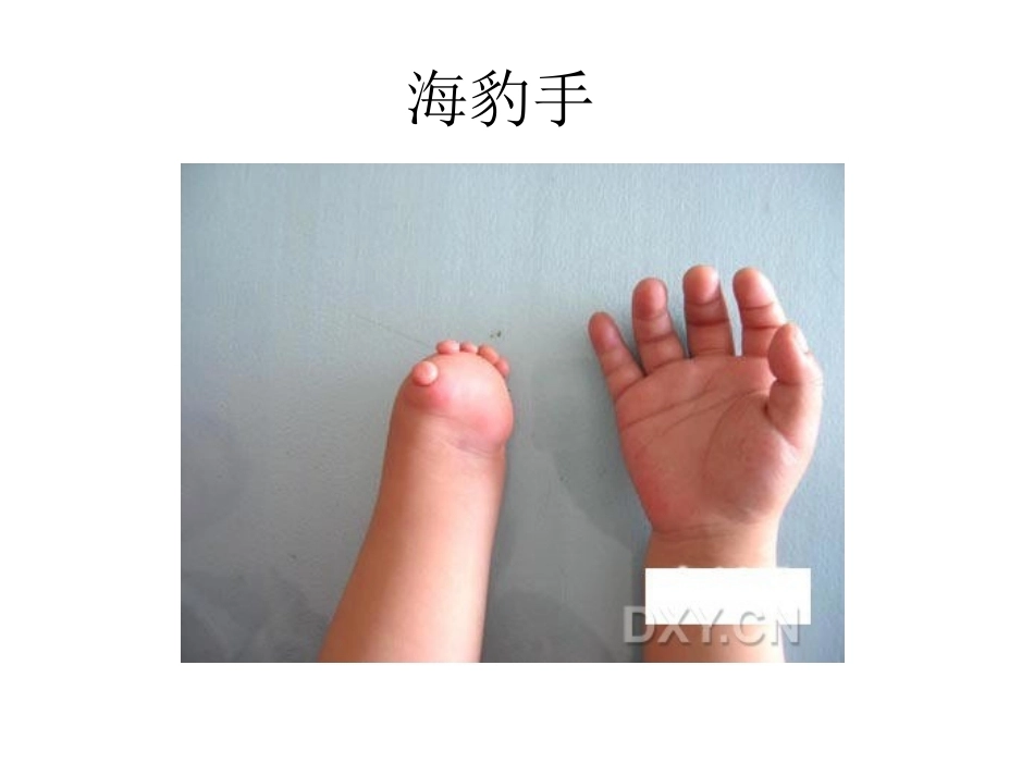 骨科特殊体征_第10页