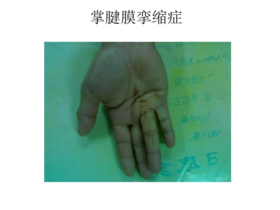 骨科特殊体征_第11页