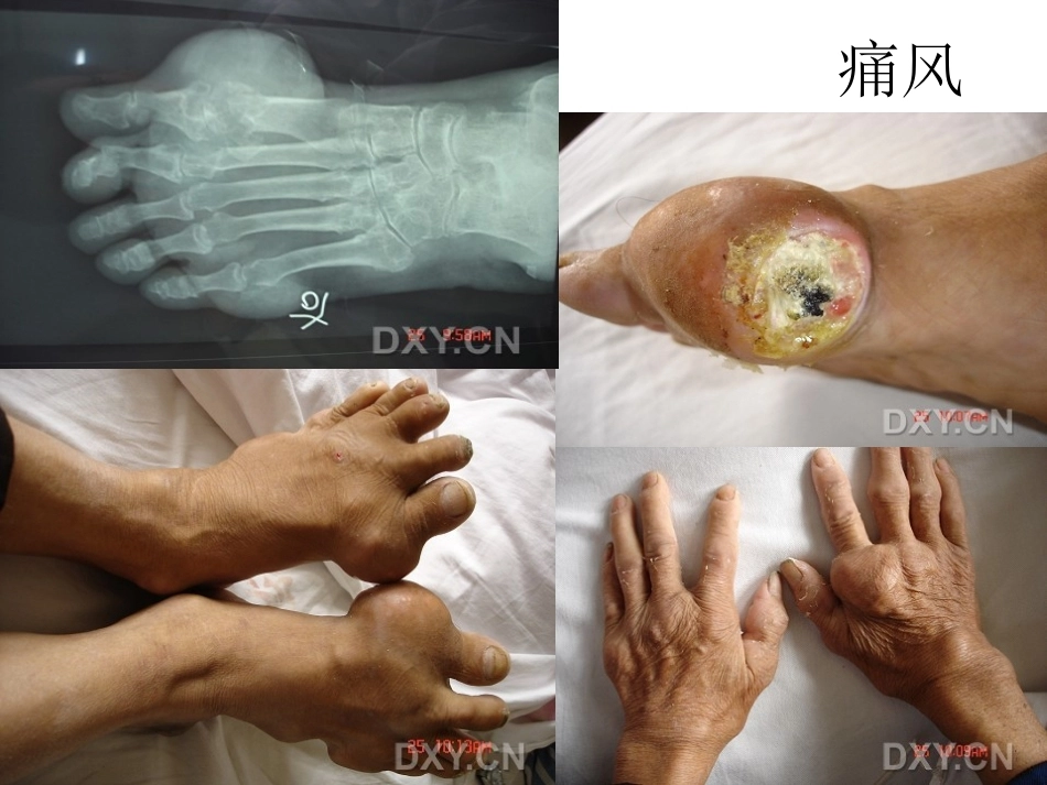 骨科特殊体征_第12页
