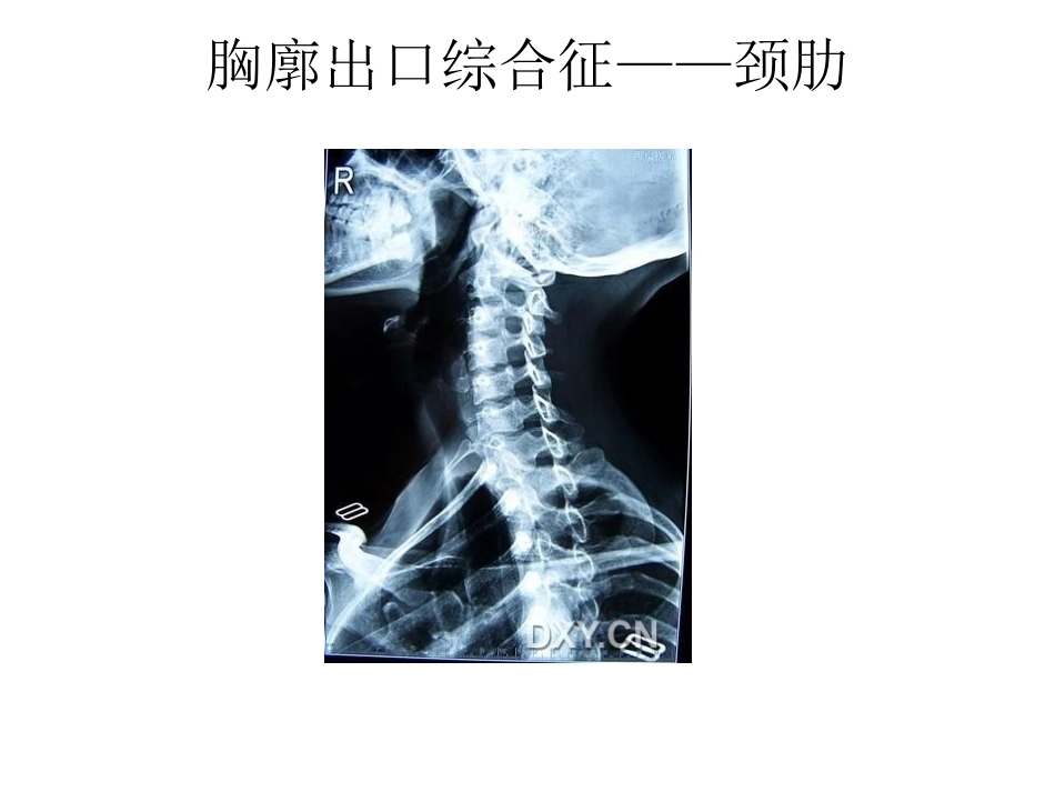 骨科特殊体征_第13页