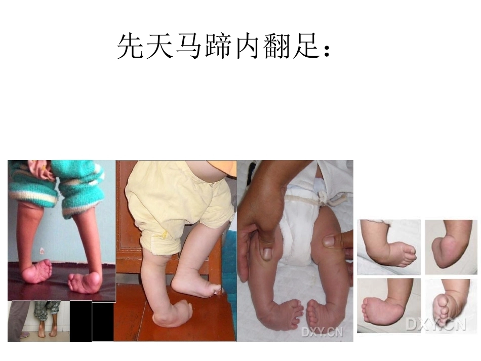 骨科特殊体征_第14页