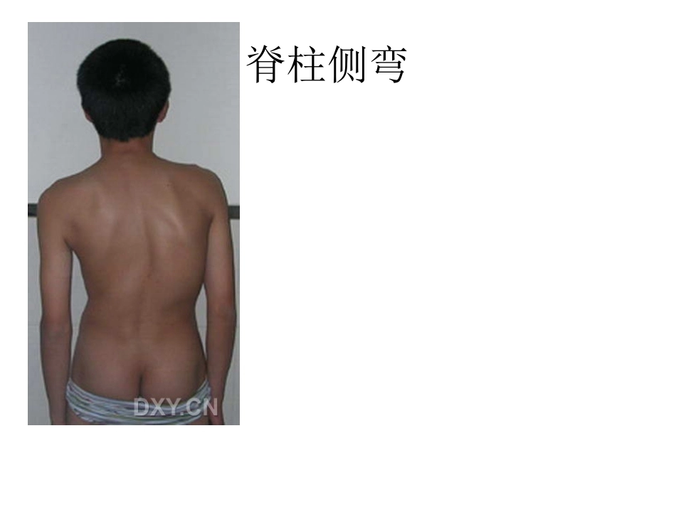 骨科特殊体征_第15页
