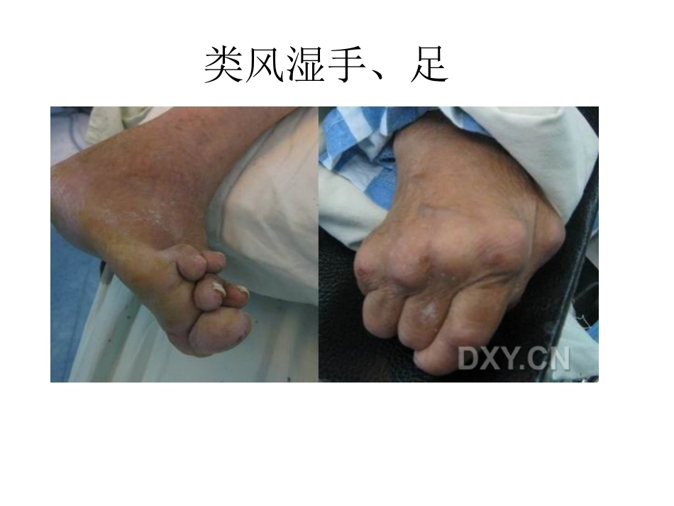 骨科特殊体征_第4页
