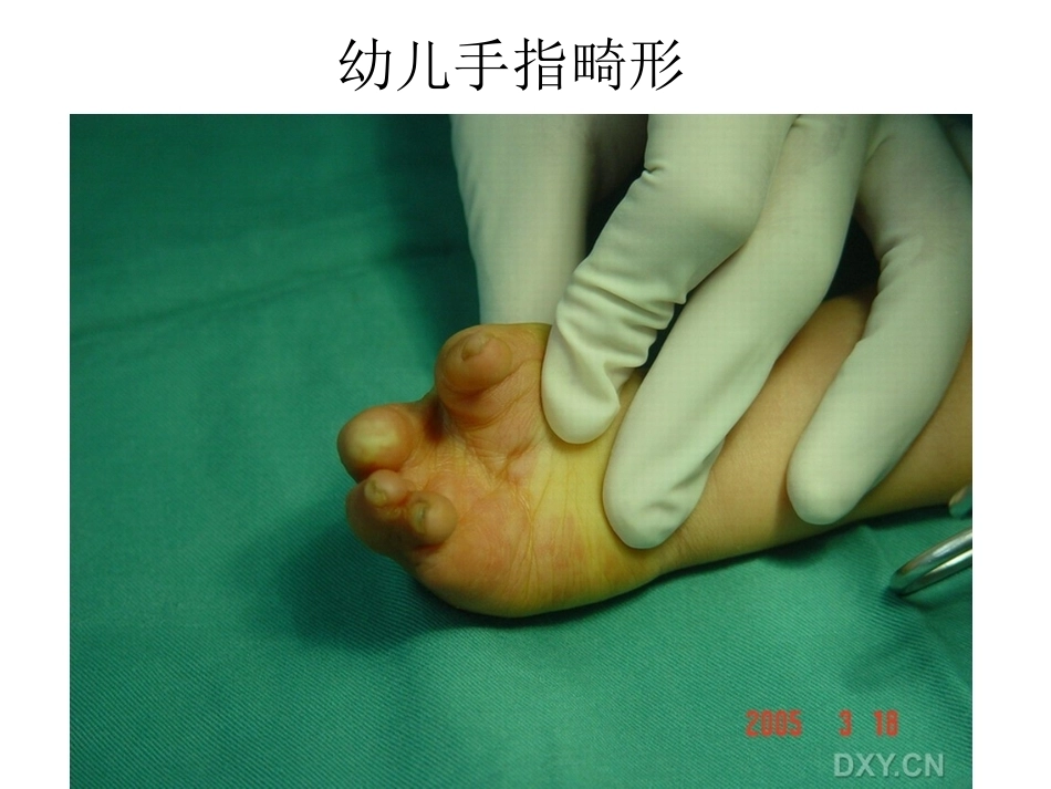 骨科特殊体征_第5页