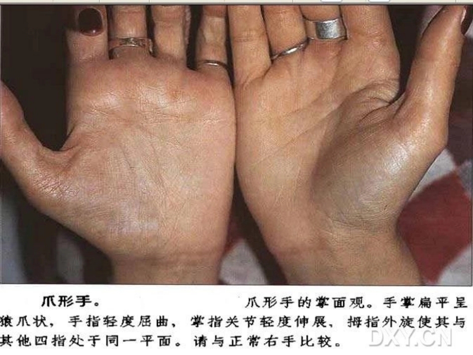 骨科特殊体征_第6页
