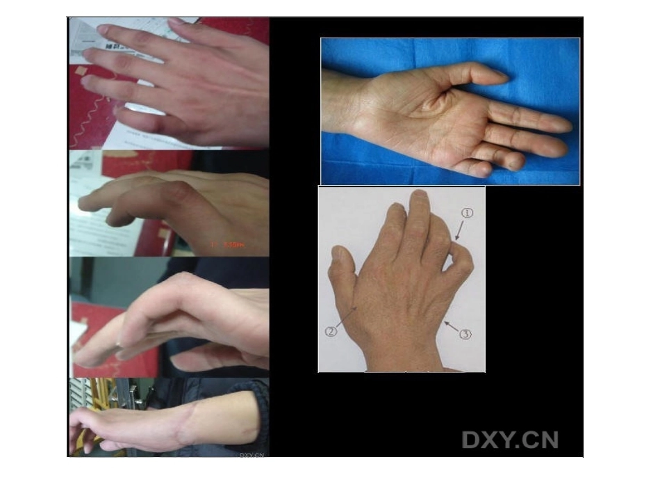 骨科特殊体征_第7页