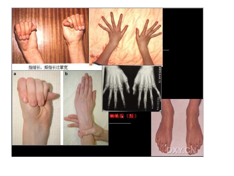 骨科特殊体征_第9页