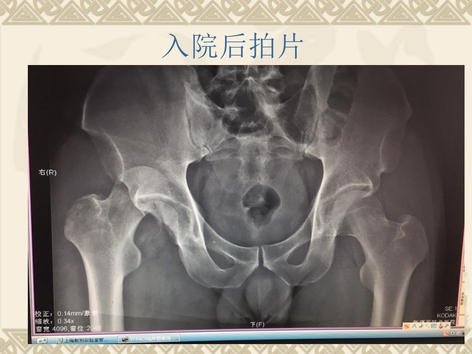 股骨头骨折_第3页