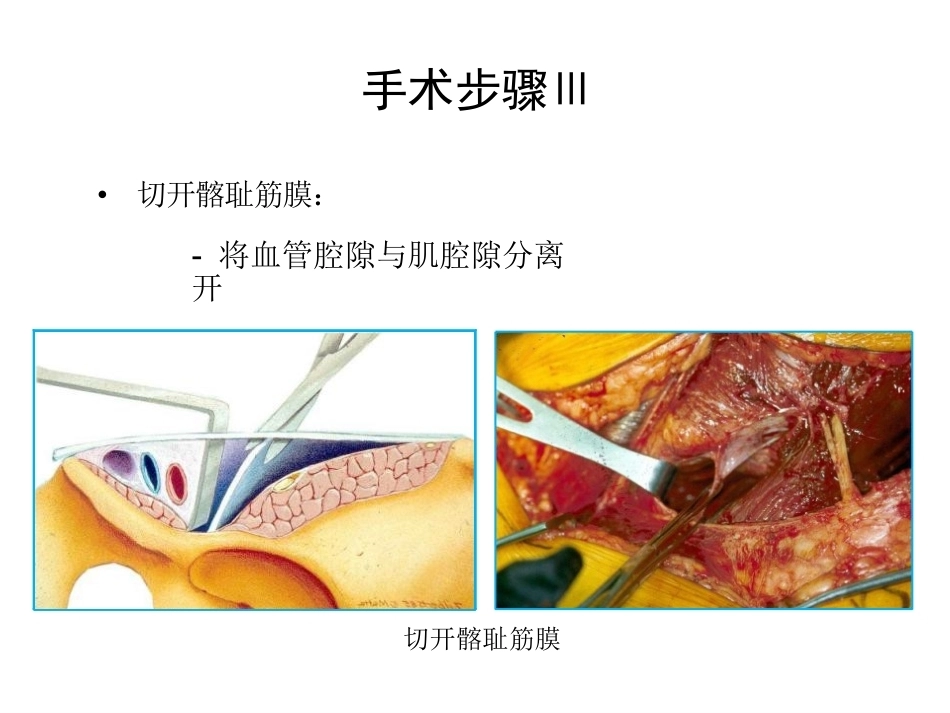 骨盆髋臼入路 选择_第11页