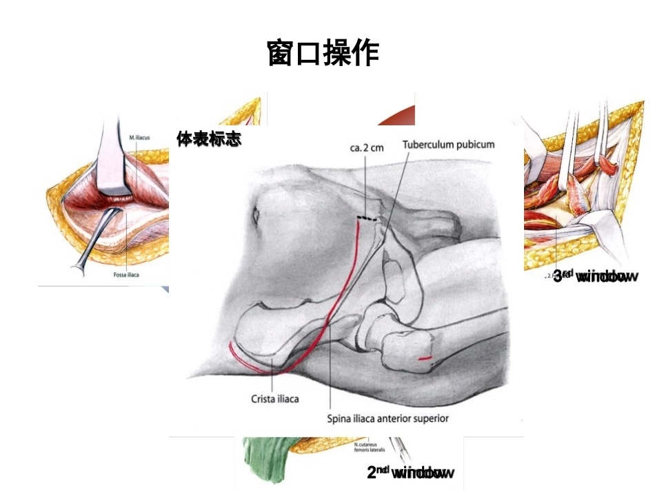 骨盆髋臼入路 选择_第12页