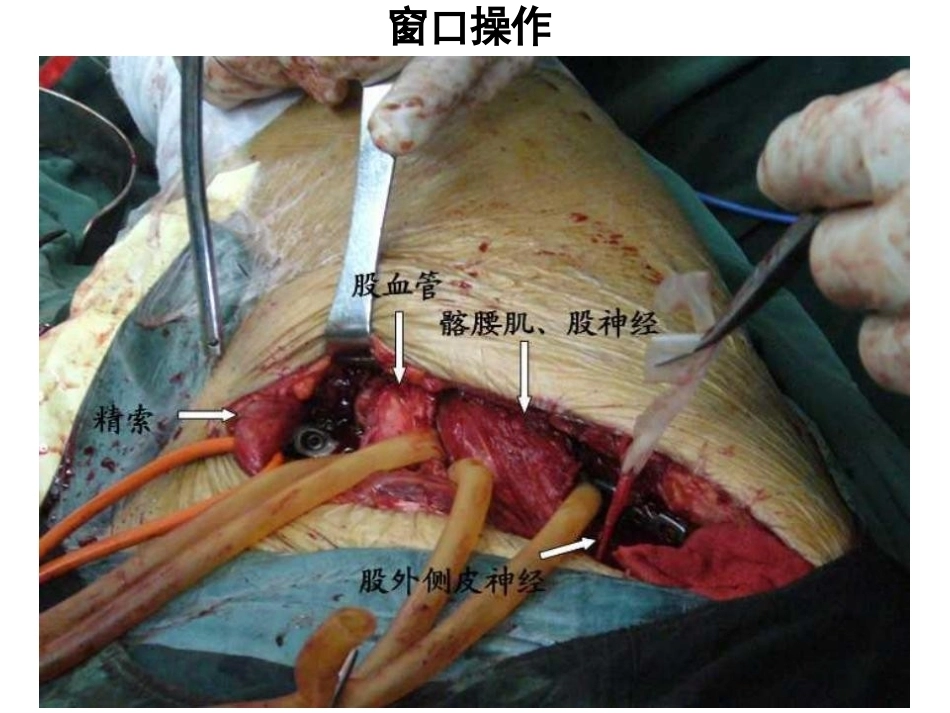 骨盆髋臼入路 选择_第13页