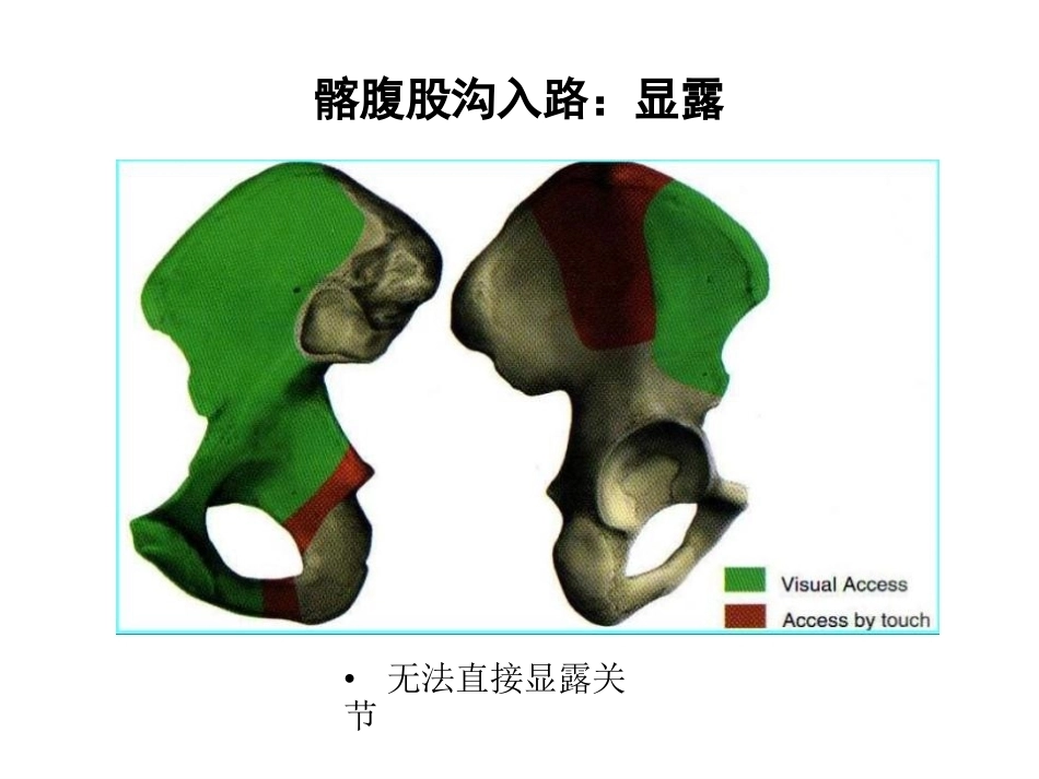 骨盆髋臼入路 选择_第6页
