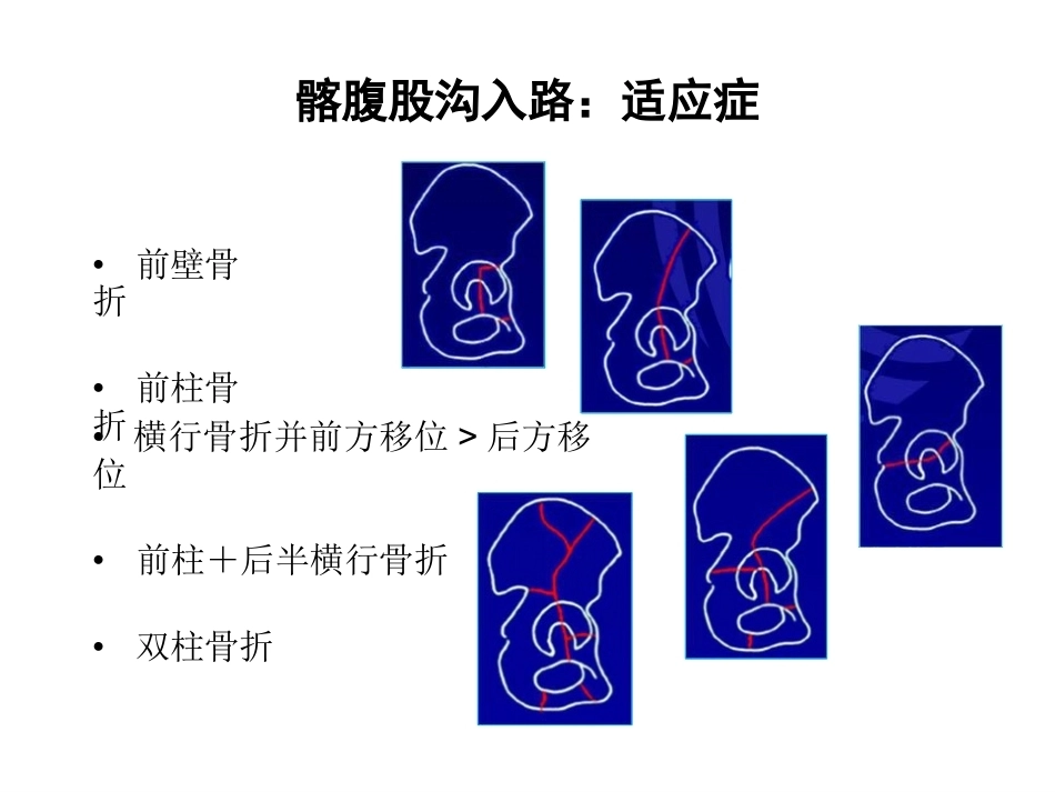 骨盆髋臼入路 选择_第7页