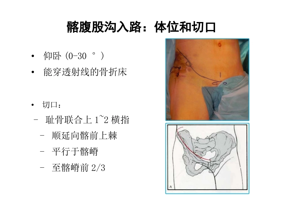 骨盆髋臼入路 选择_第8页