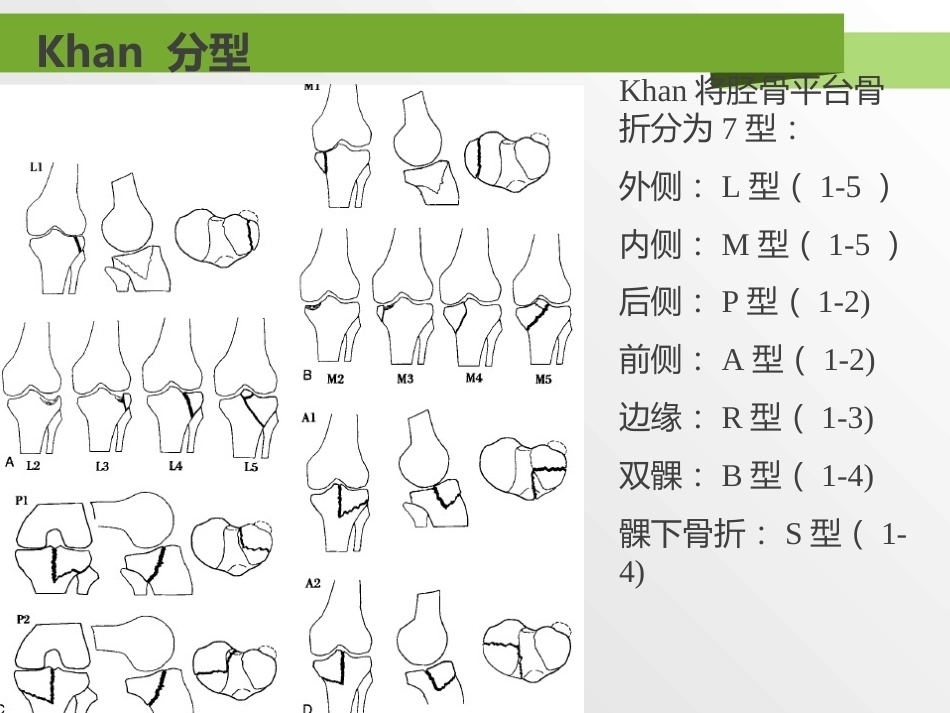 胫骨平台骨折分型_第12页
