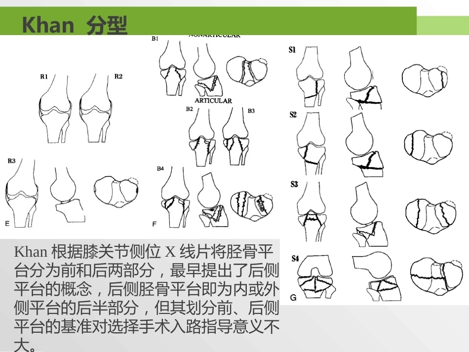 胫骨平台骨折分型_第13页