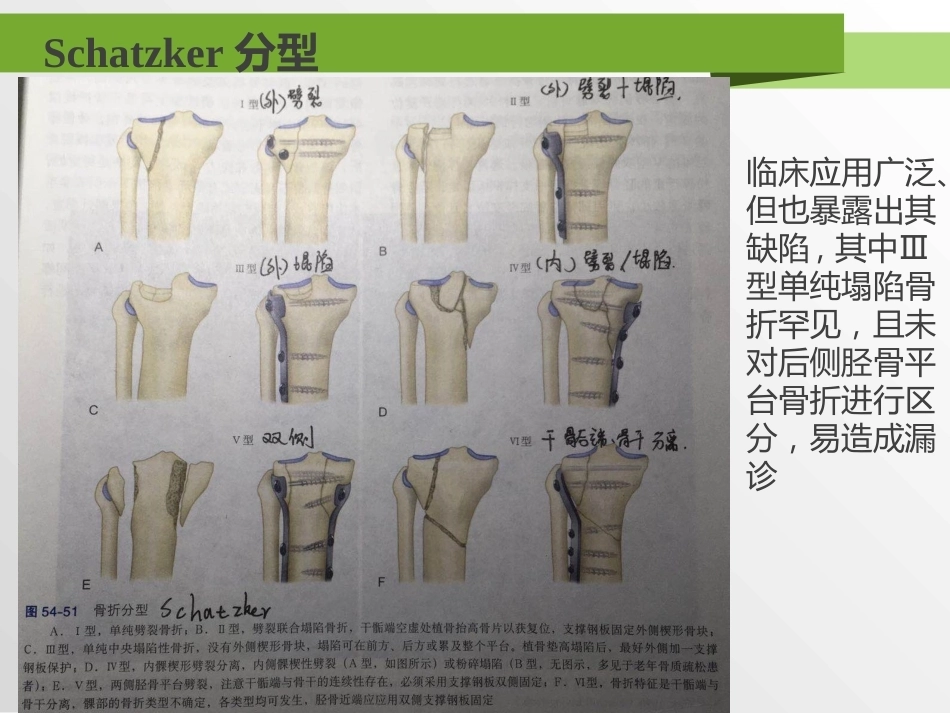 胫骨平台骨折分型_第7页