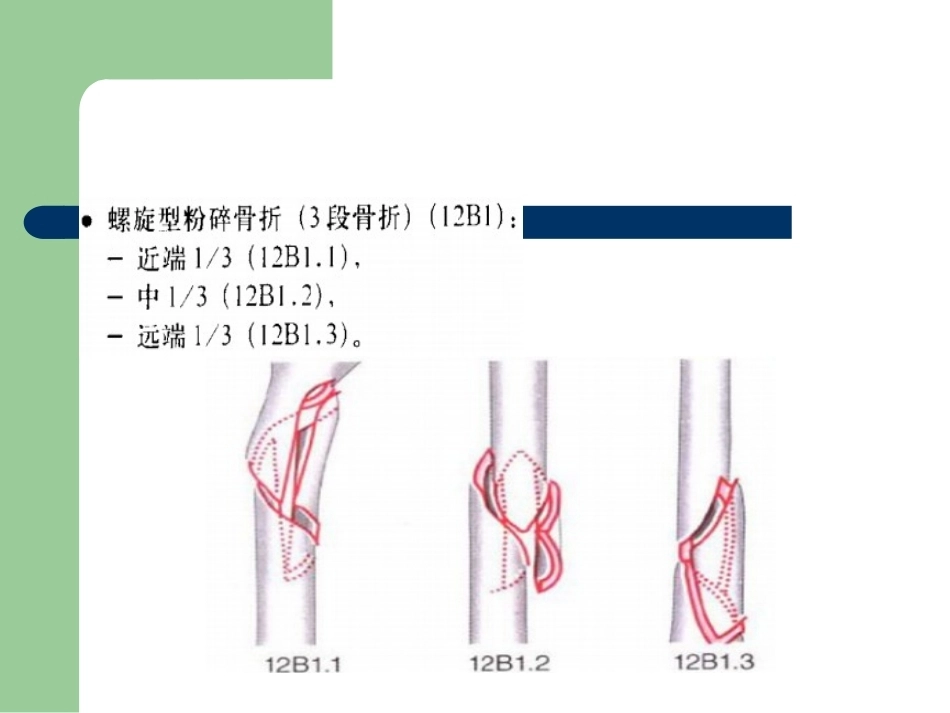 骨折分型_第11页