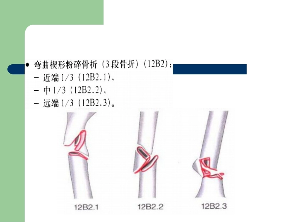 骨折分型_第12页