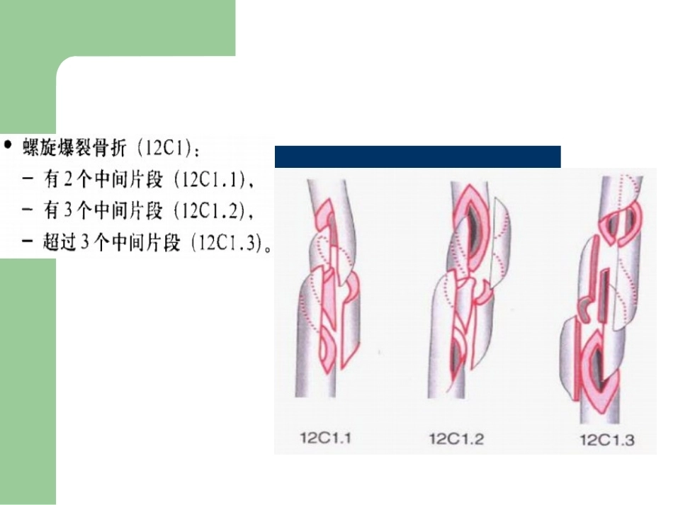骨折分型_第14页