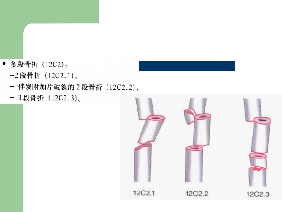 骨折分型_第15页
