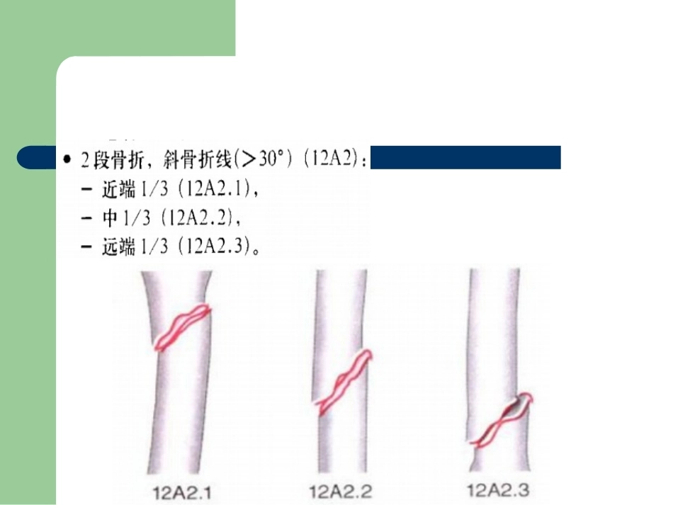 骨折分型_第9页