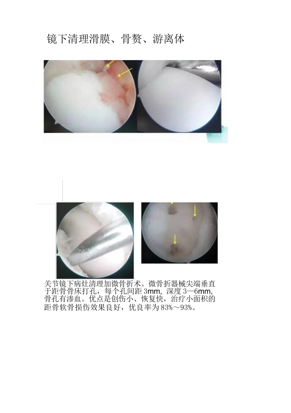距骨软骨损伤的分期及治疗_第10页