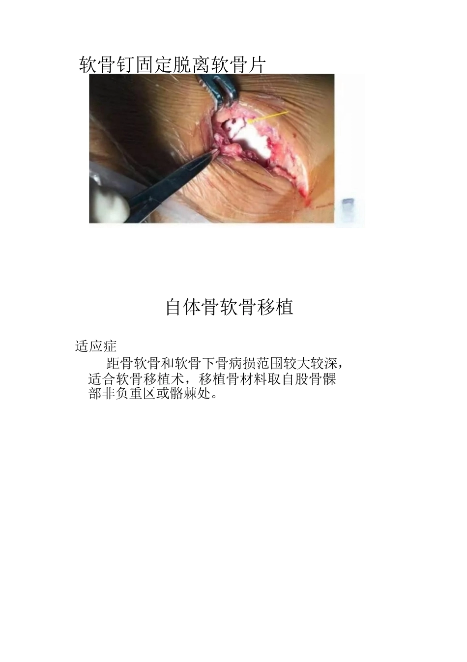距骨软骨损伤的分期及治疗_第14页
