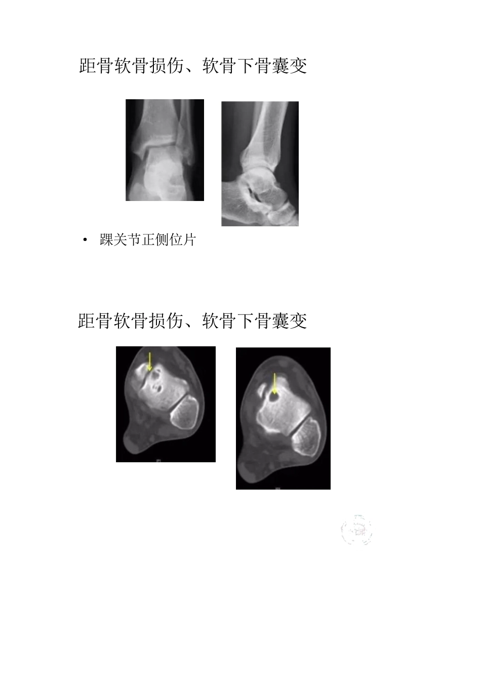距骨软骨损伤的分期及治疗_第15页