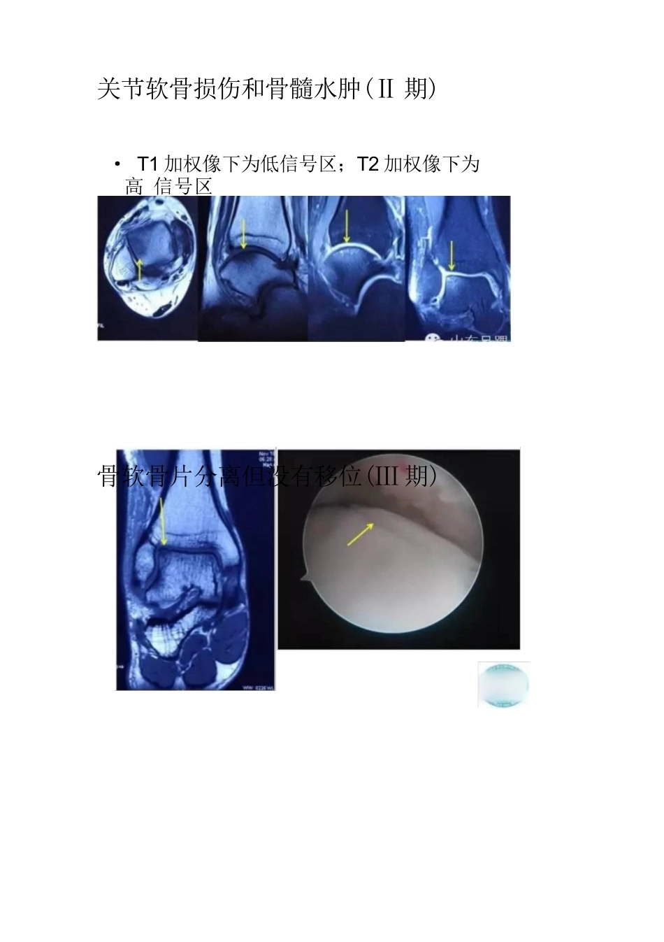 距骨软骨损伤的分期及治疗_第4页