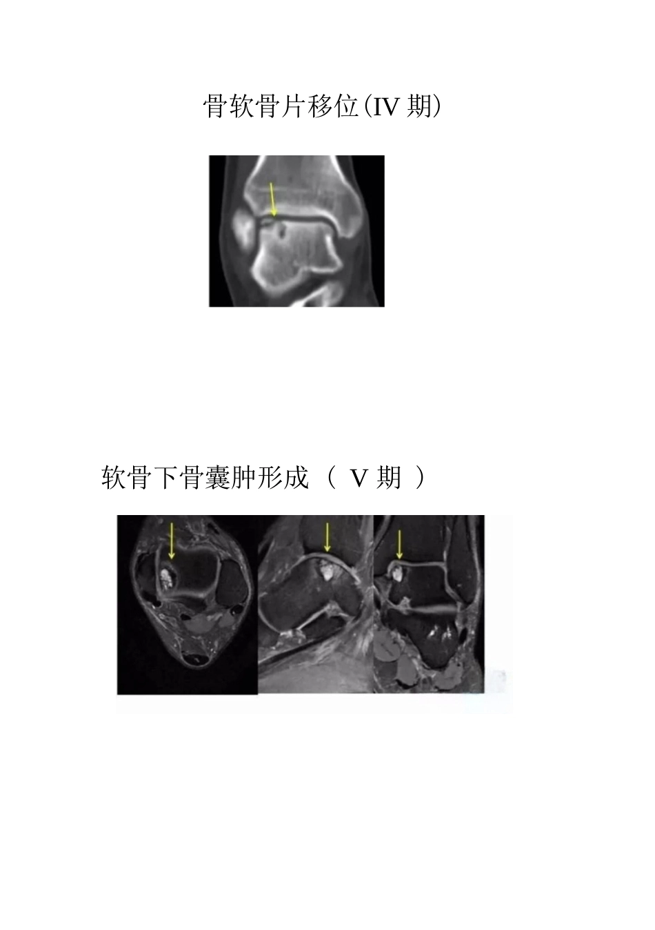 距骨软骨损伤的分期及治疗_第5页