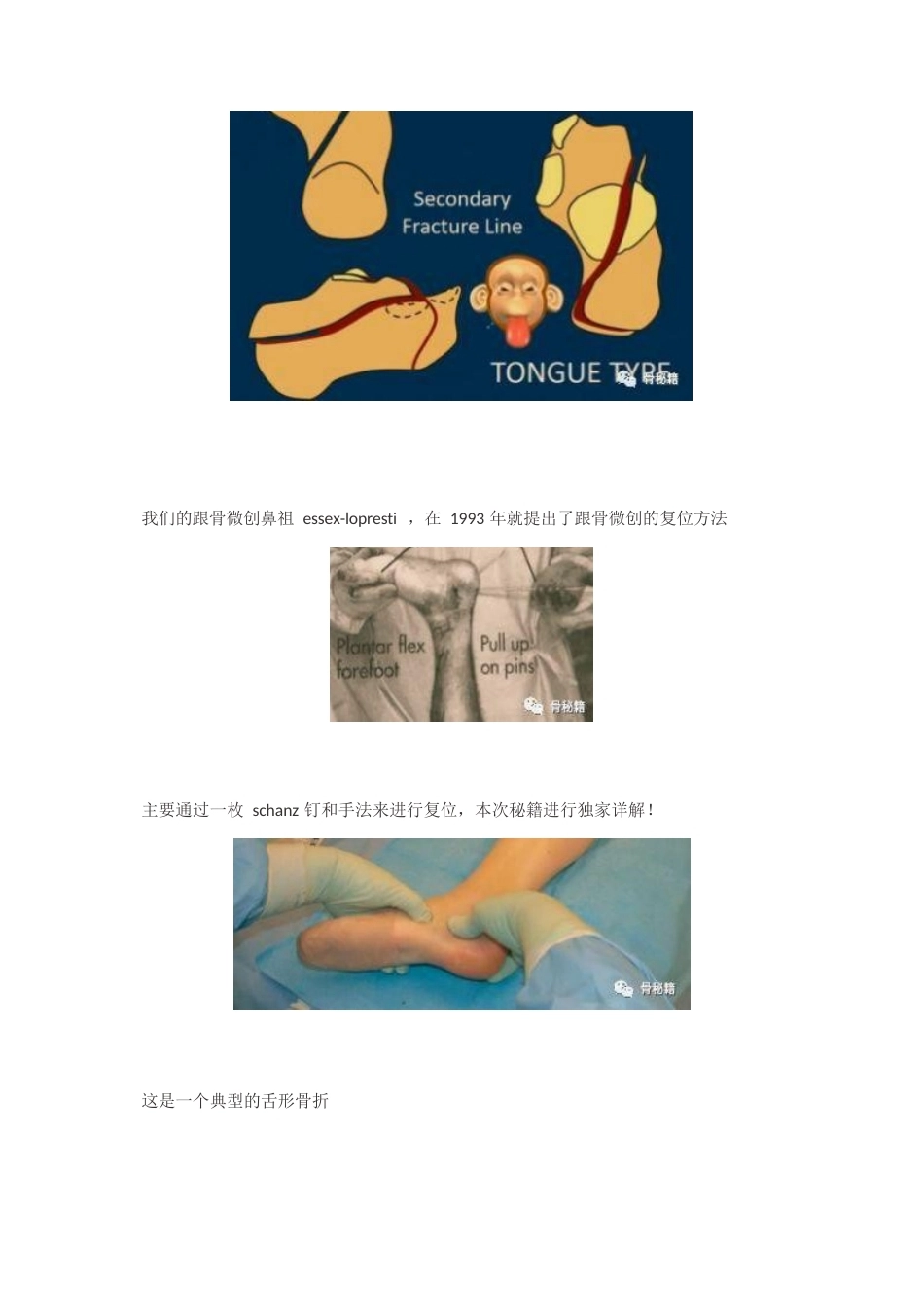 跟骨舌形骨折闭 合复位技巧_第2页