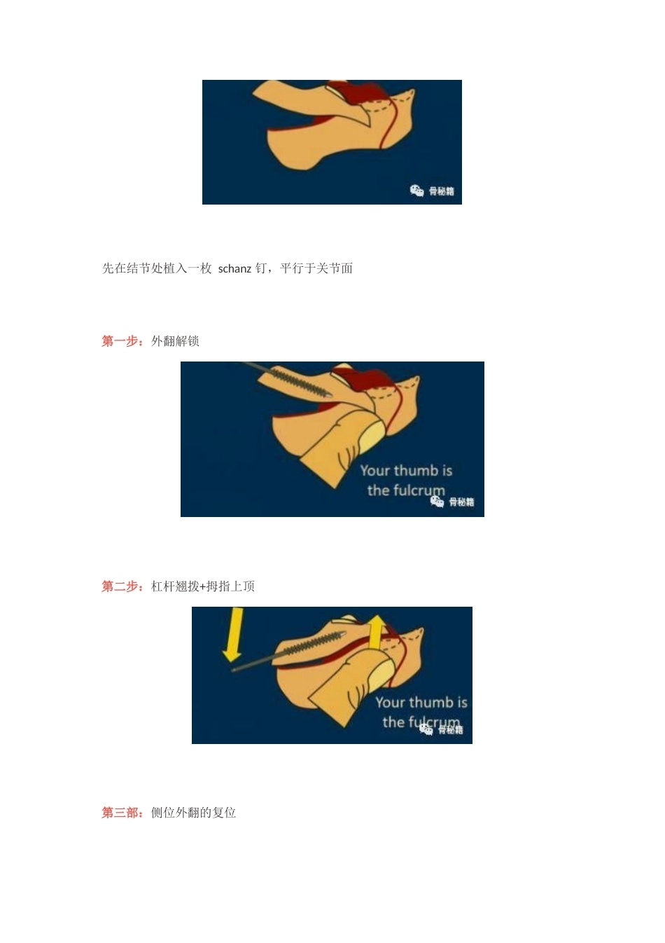 跟骨舌形骨折闭 合复位技巧_第3页