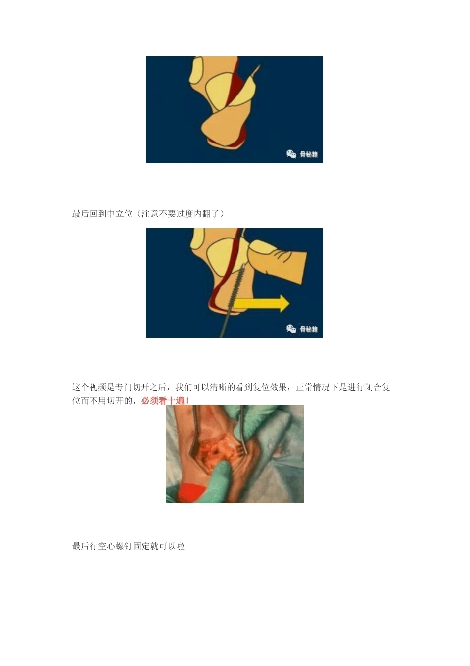 跟骨舌形骨折闭 合复位技巧_第4页