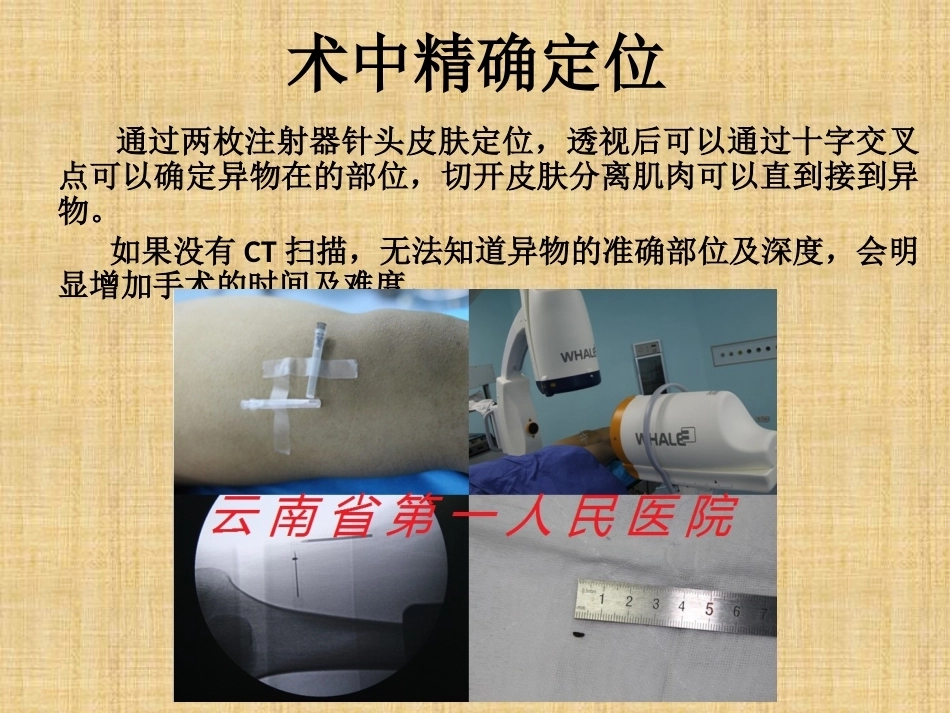 精准外科技术在四肢金属异物取 出中的应用_第10页