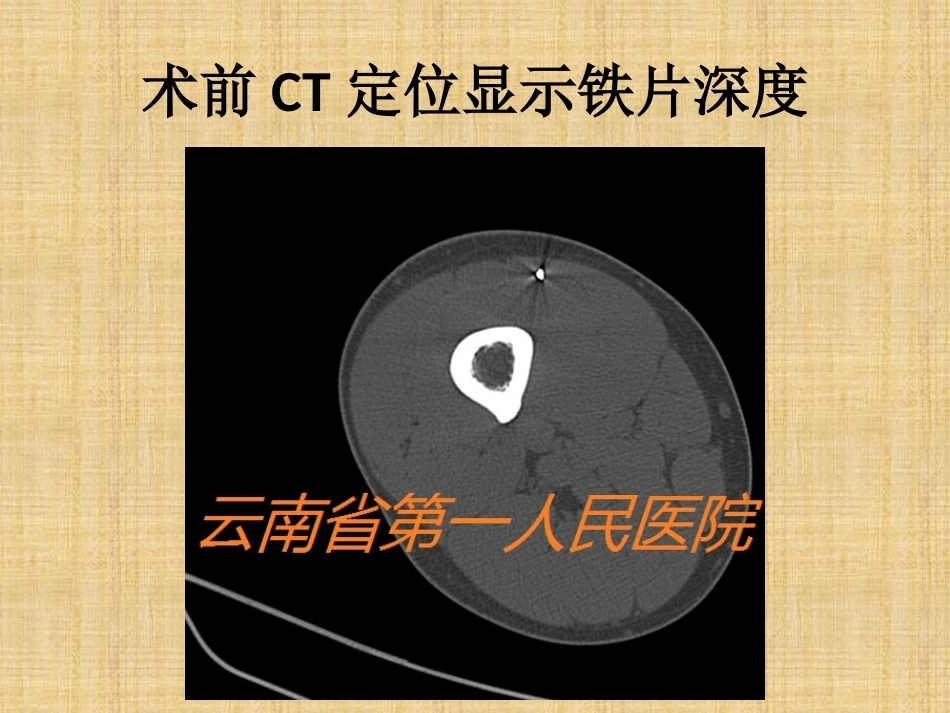 精准外科技术在四肢金属异物取 出中的应用_第12页