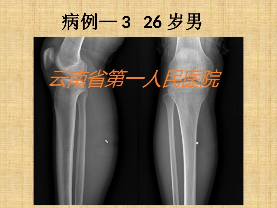 精准外科技术在四肢金属异物取 出中的应用_第14页