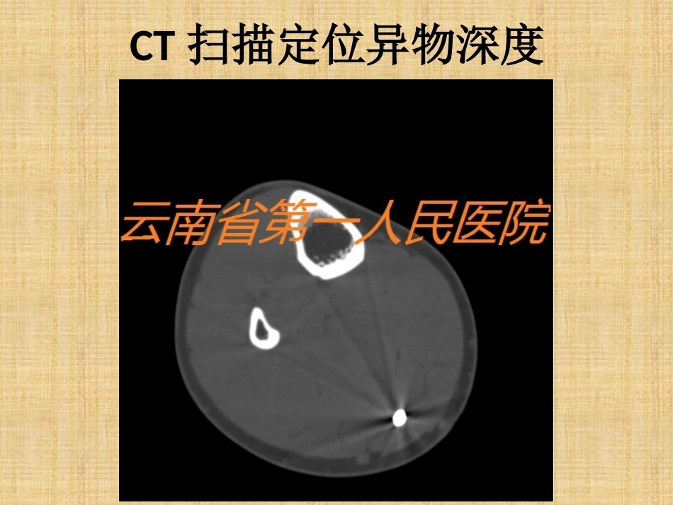 精准外科技术在四肢金属异物取 出中的应用_第15页