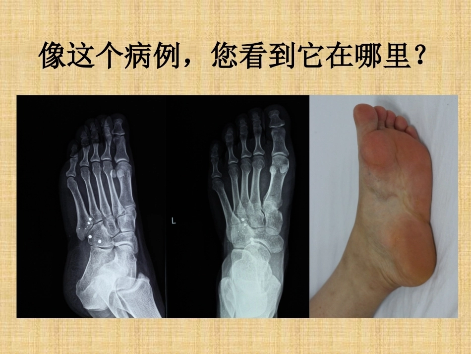 精准外科技术在四肢金属异物取 出中的应用_第7页