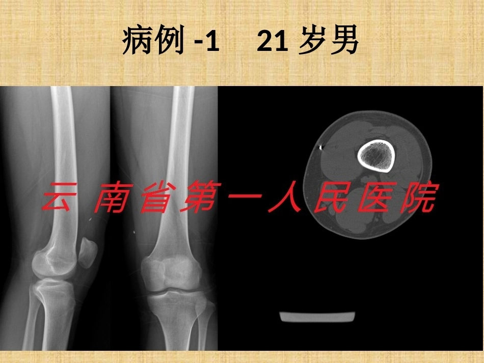 精准外科技术在四肢金属异物取 出中的应用_第9页