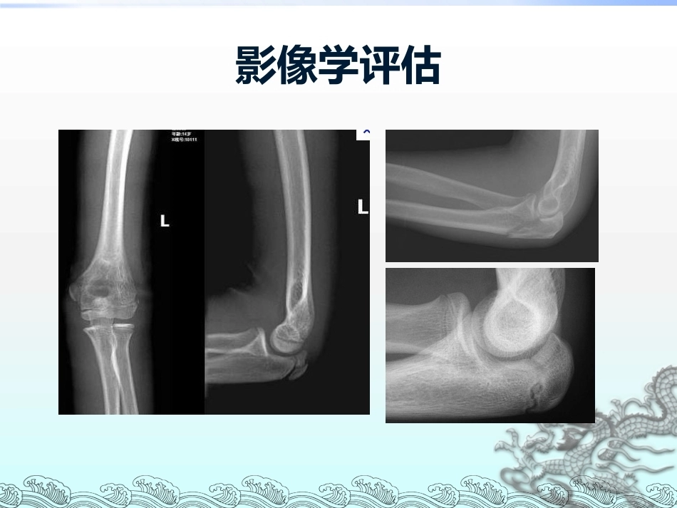 尺骨鹰嘴骨折_第10页