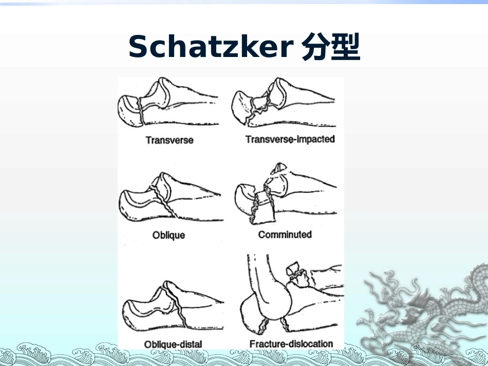 尺骨鹰嘴骨折_第15页