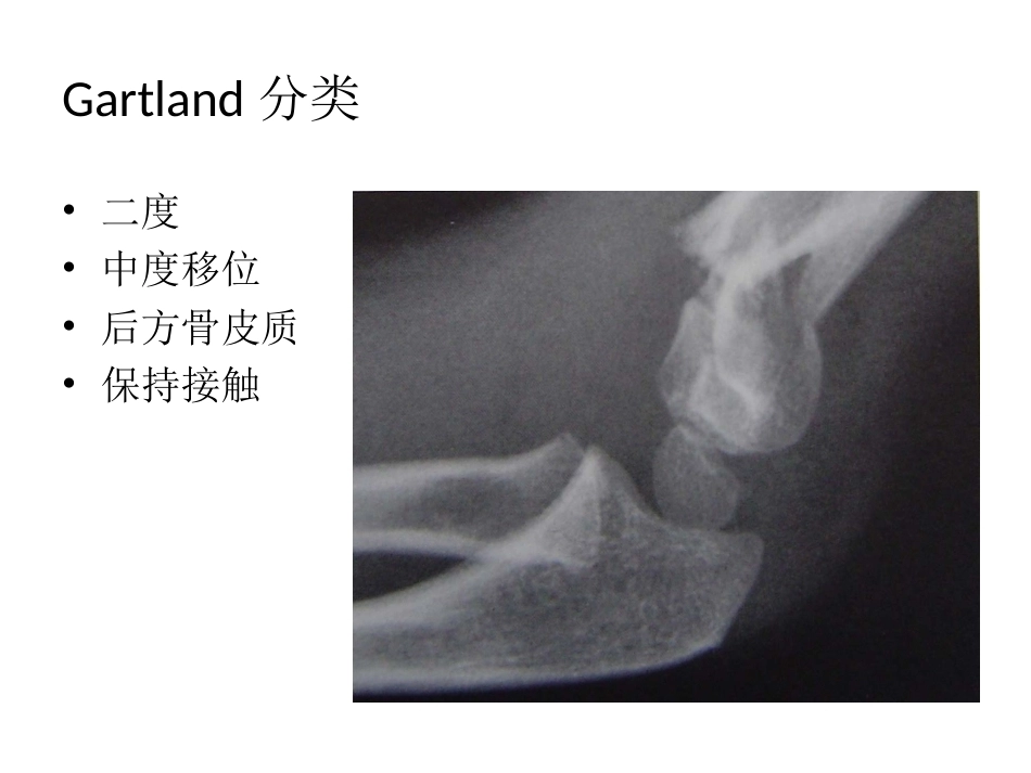 小儿肱骨髁上骨折_第10页