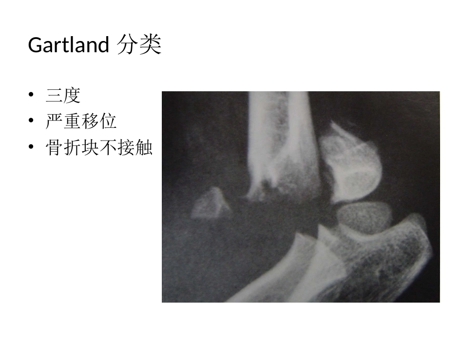 小儿肱骨髁上骨折_第11页