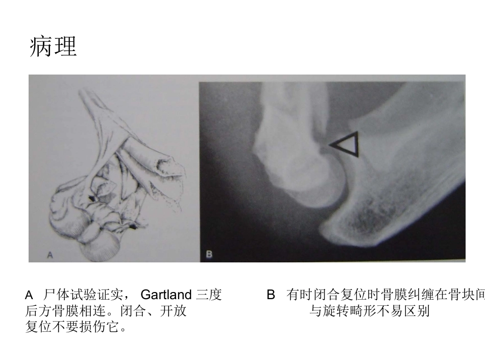 小儿肱骨髁上骨折_第12页